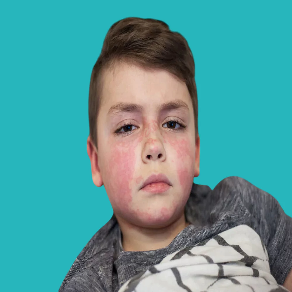 Symptoms of scarlet fever in children and methods of treatment 
