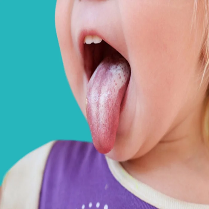 افضل ادوية علاج فطريات الفم عند الاطفال 