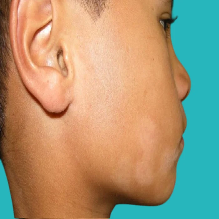 causes of white pityriasis in children and ways to treat it 