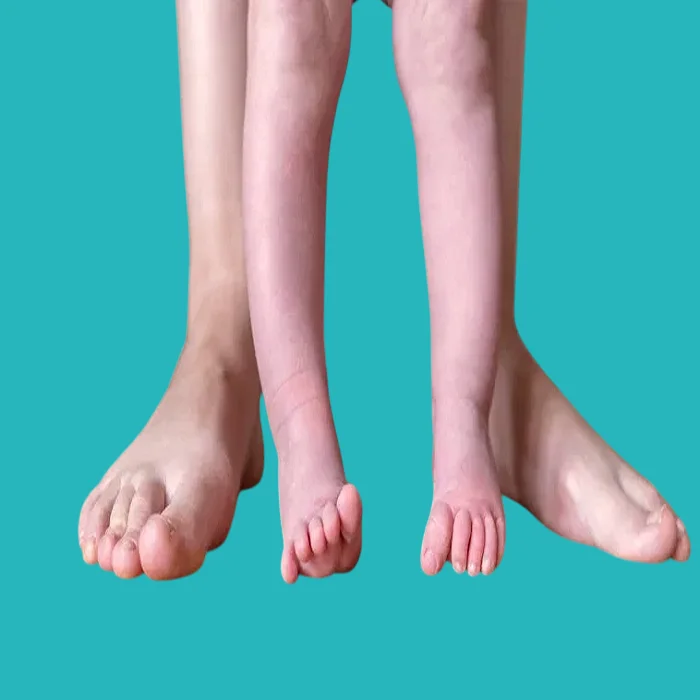 what is the difference between bow legs and rickets? 