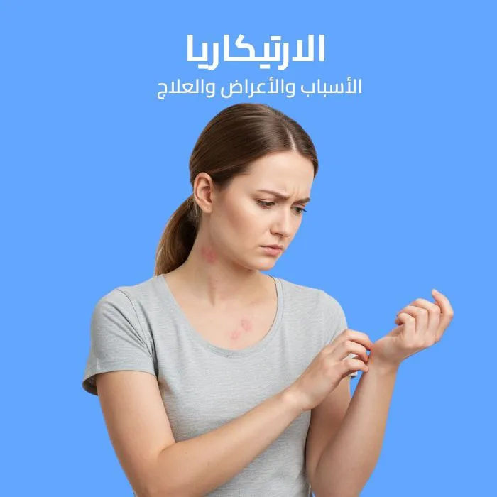 الارتيكاريا: الأسباب والأعراض والعلاج 