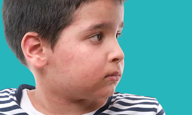 skin allergies