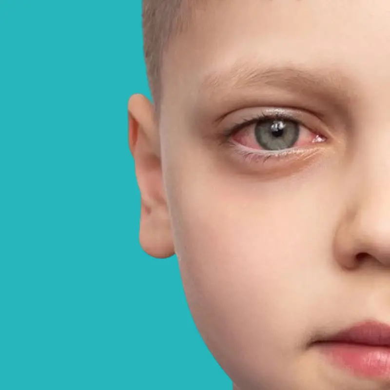 كيفية علاج احمرار العين المتكرر عند الاطفال؟ 