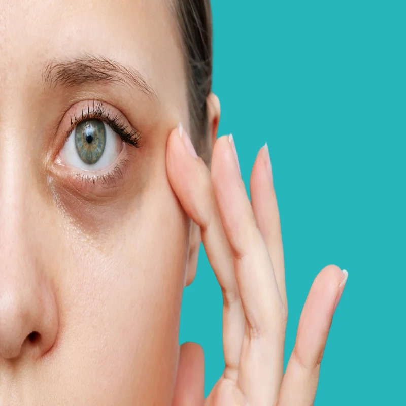 what is the treatment for dark circles and what are their main causes? 