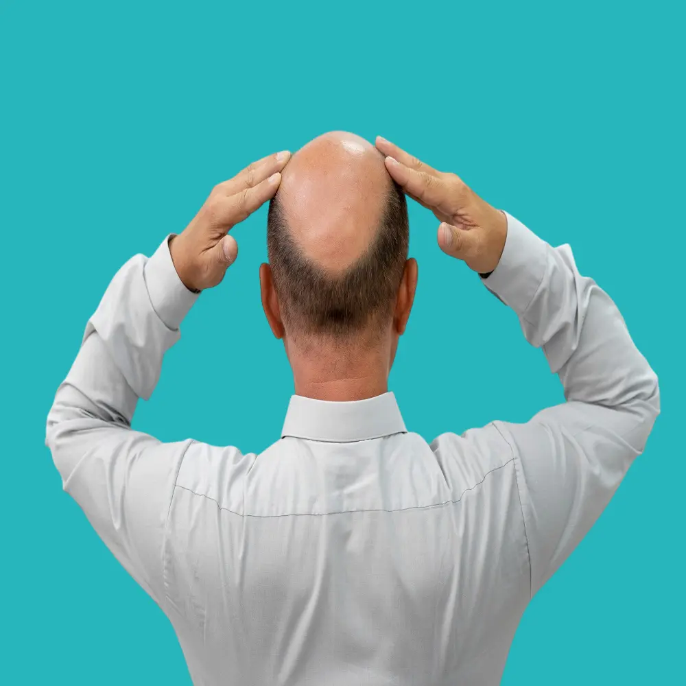 what is the difference between hereditary and non hereditary baldness? 