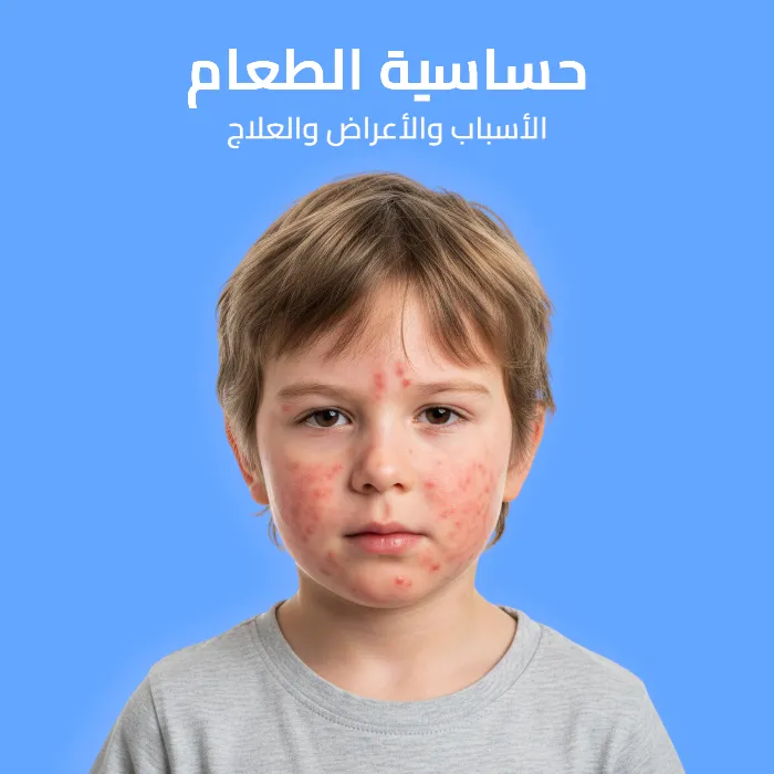 حساسية الطعام: الأسباب والأعراض والعلاج 