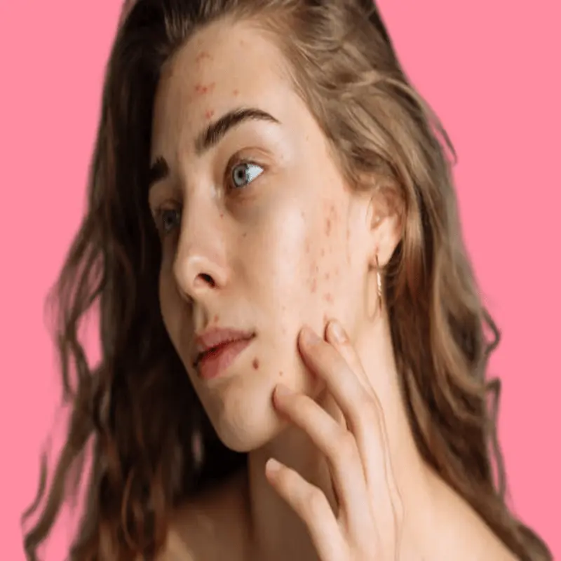 Methods for treating different skin pigmentation conditions 