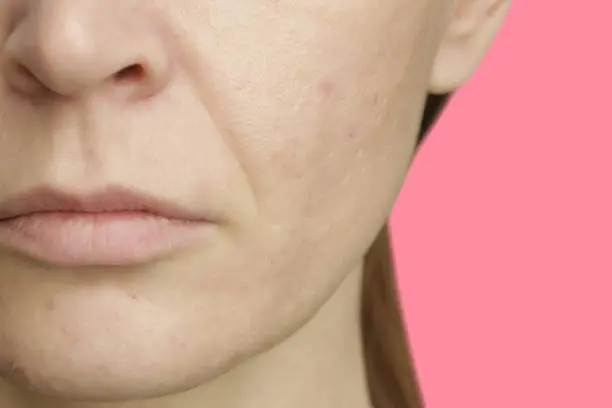 Habits that increase skin dryness