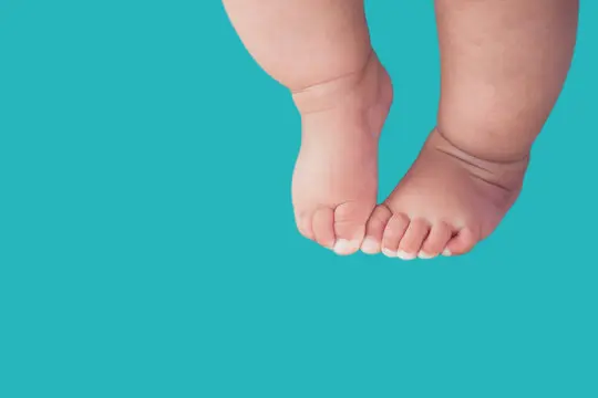 تقوس الساقين عند الرضع