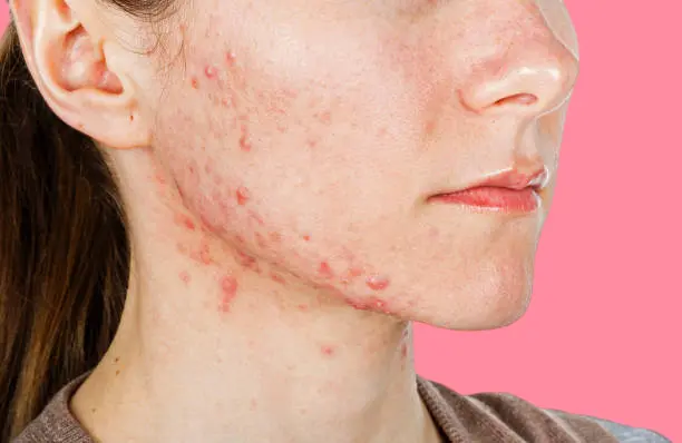 Skin irritation after filler injections