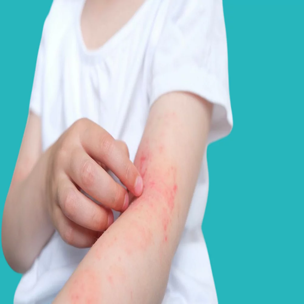 Causes of skin allergies in children and their treatment 
