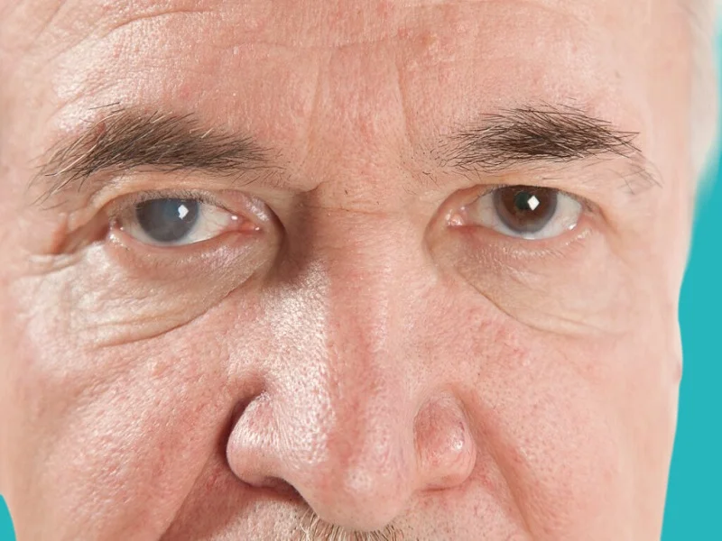 وجود بياض في عدسة العين من اعراض اعتام عدسة العين