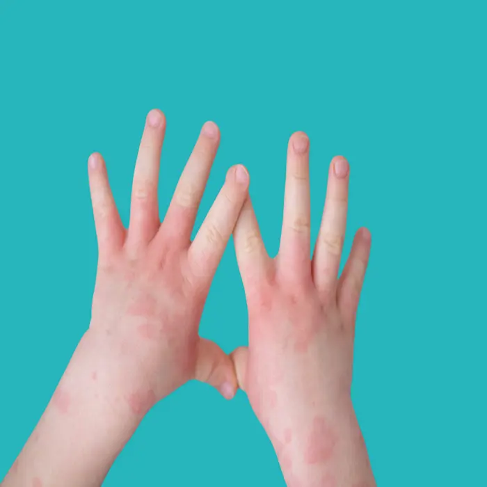 افضل كريم لعلاج الاكزيما عند الاطفال 