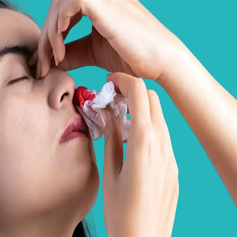 علاج نزيف الانف واسباب الاصابة به 