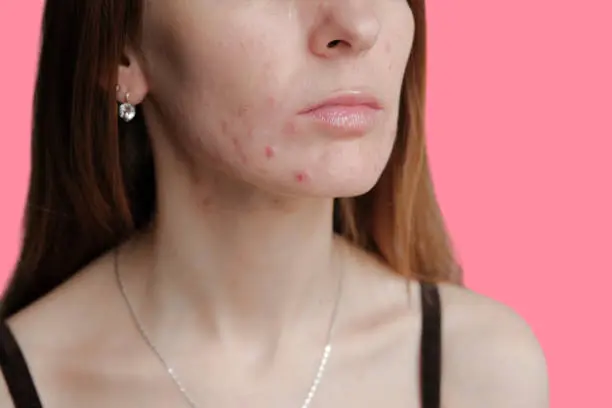 The harmful effects of toothpaste on the skin