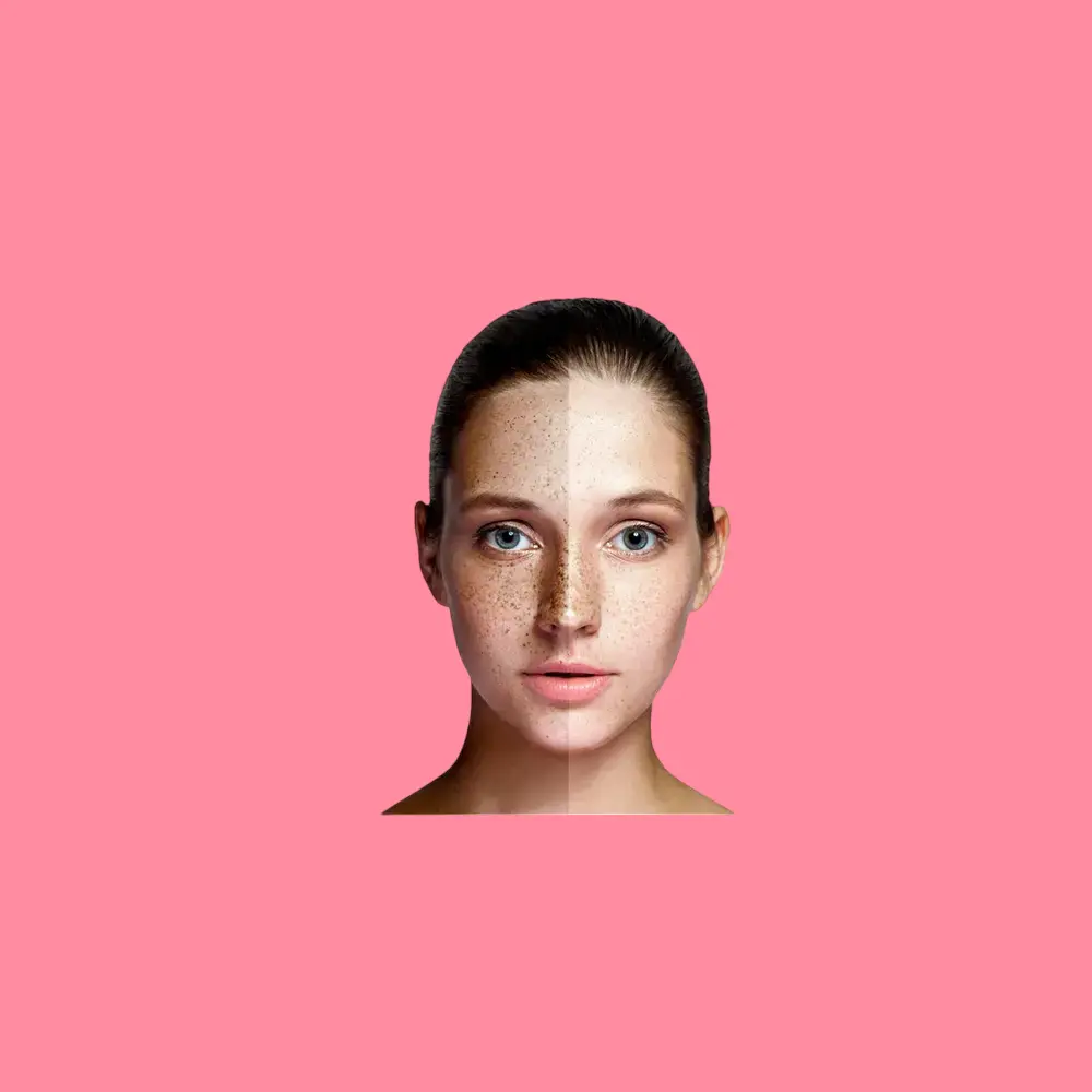 الكلف عند السيدات اسبابه وطرق علاجه 