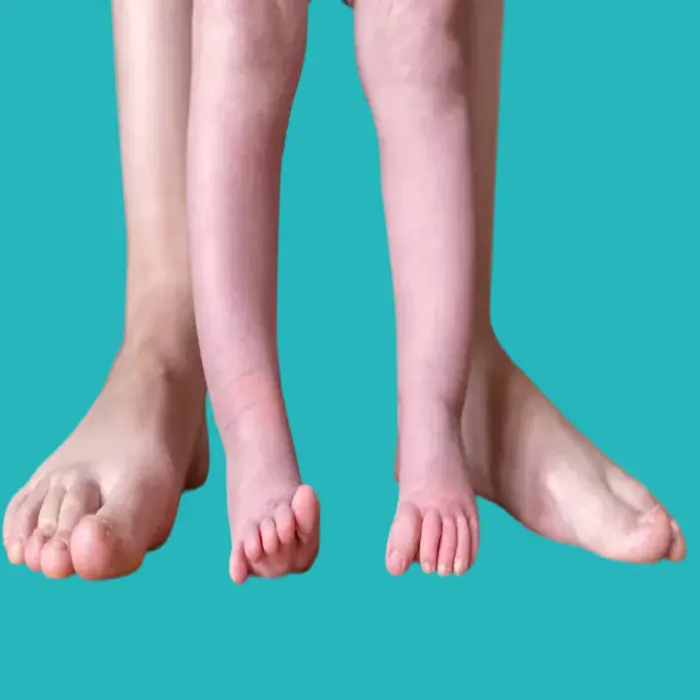 what is the difference between bow legs and rickets? 