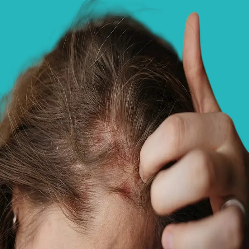 treatment of ringworm of the scalp and how to get rid of it 