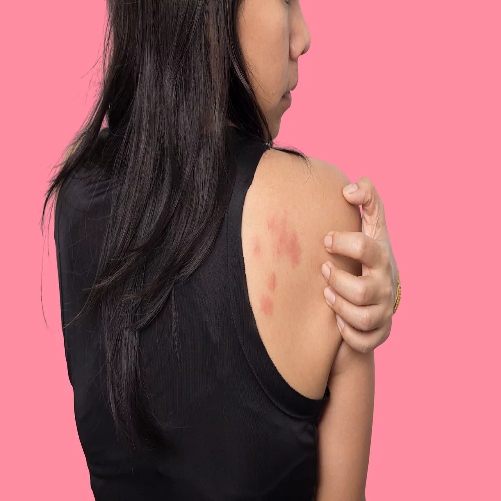 Causes of urticaria in women and methods of treatment 