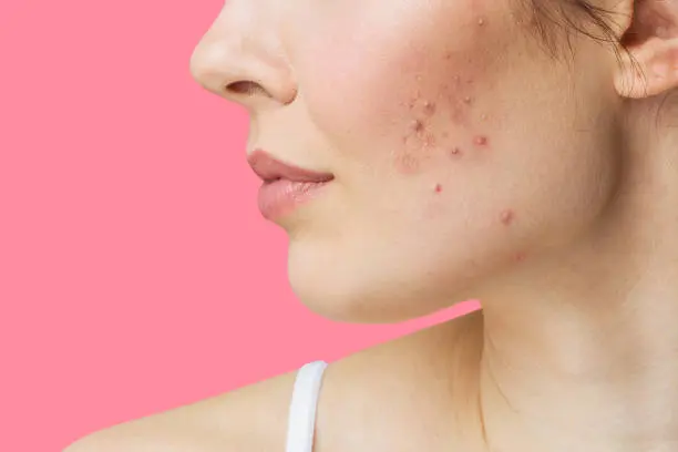 Increased appearance of pimples