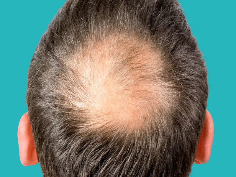 فراغات الشعر في تاج الرأس من علامات الصلع الوراثي