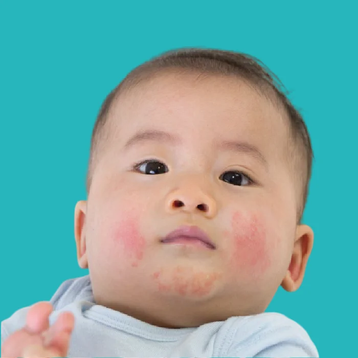 causes of eczema in children and methods of treatment 