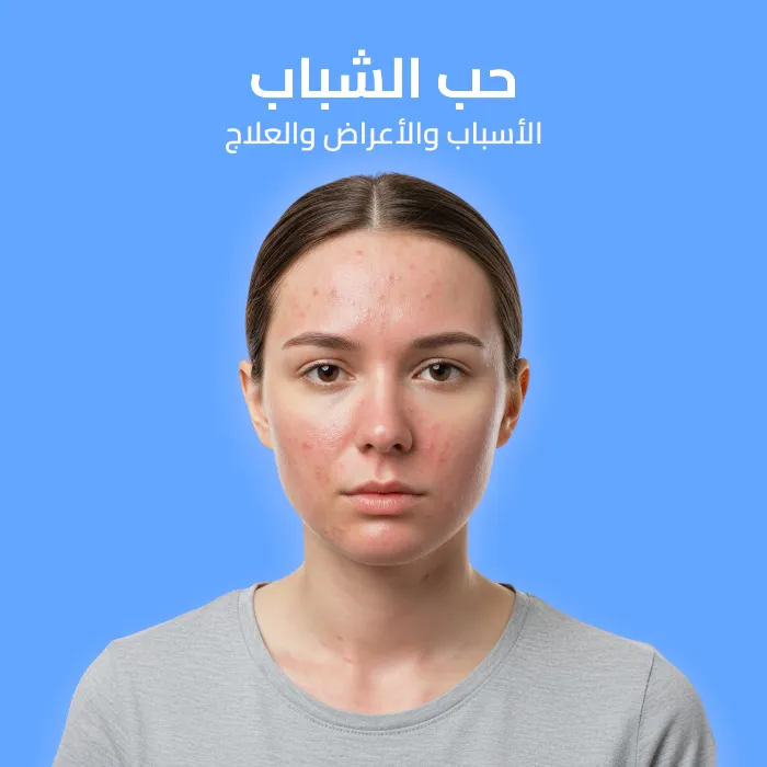acne vulgaris: causes, symptoms, and treatment 