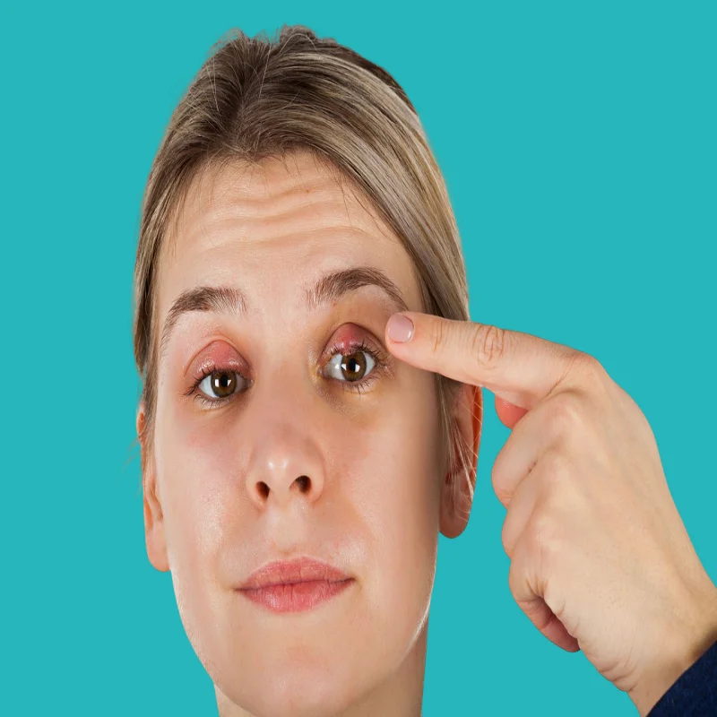 what is the treatment and what are the symptoms of a chalazion? 