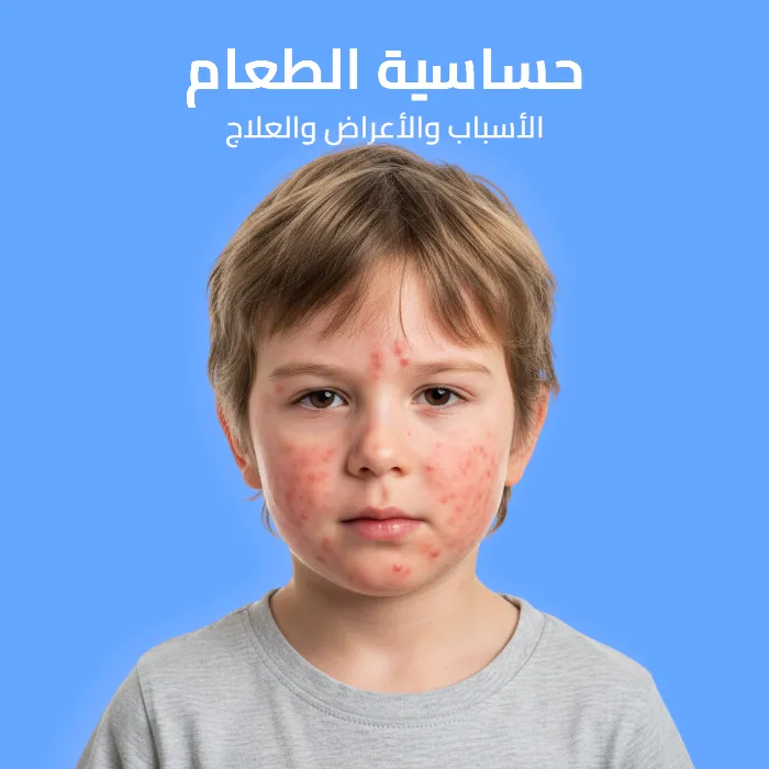 حساسية الطعام: الأسباب والأعراض والعلاج 