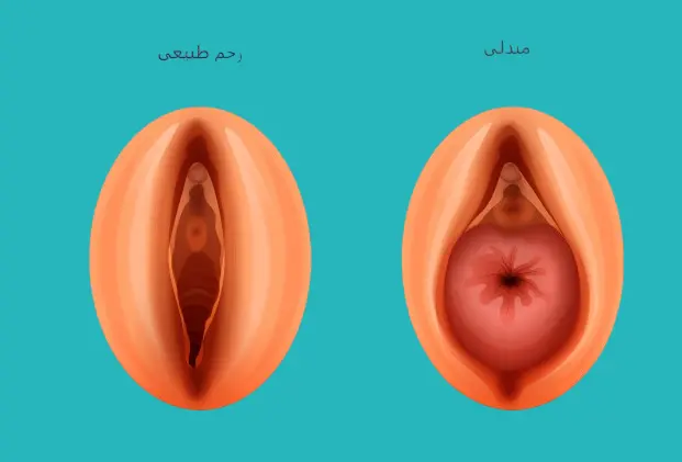 هبوط الرحم