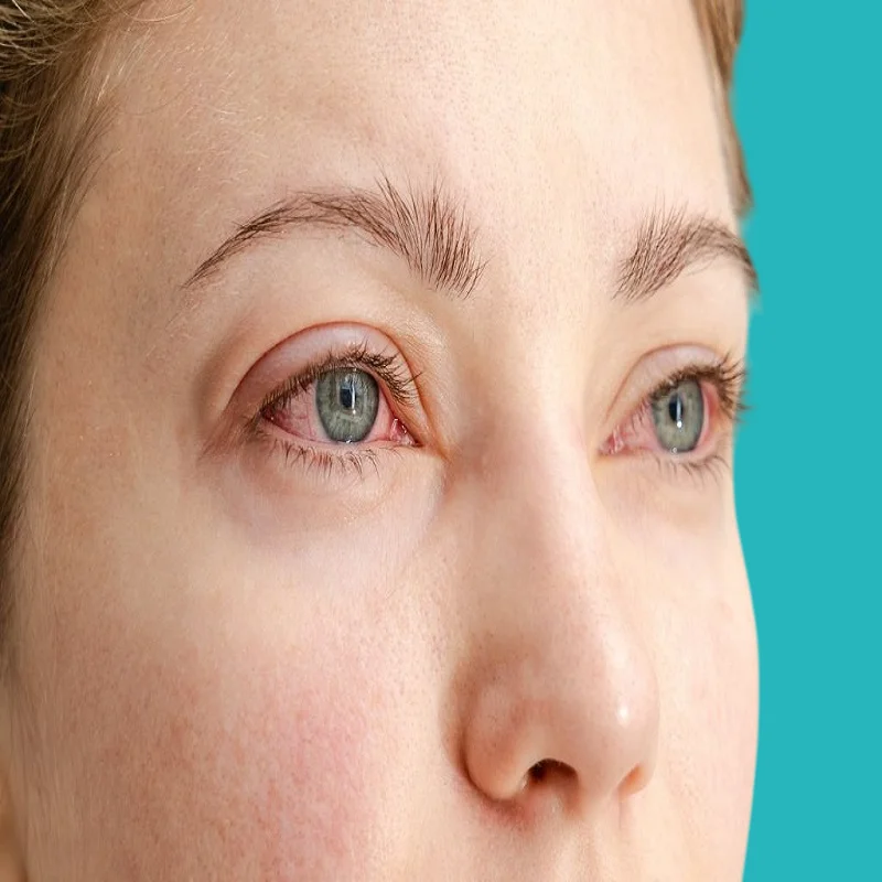 علاج احمرار العين واسبابه 