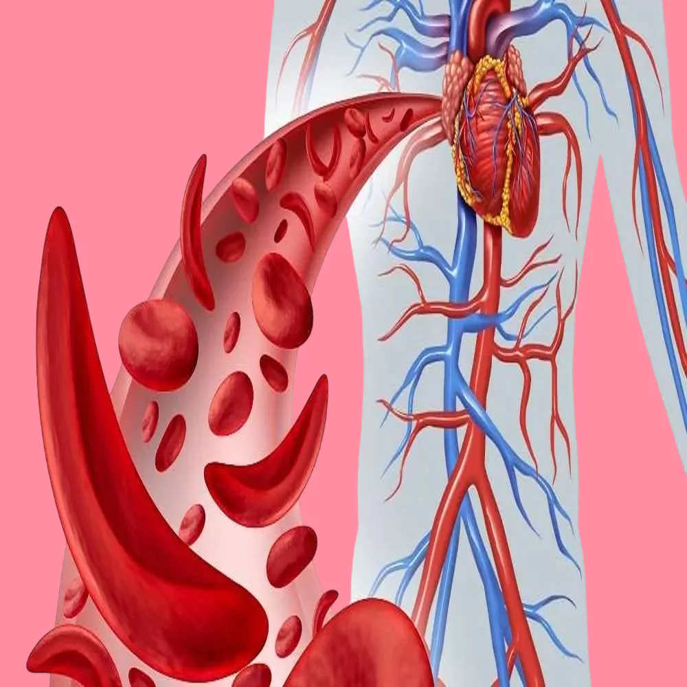 Symptoms of sickle cell anemia in women and its effect on pregnancy 