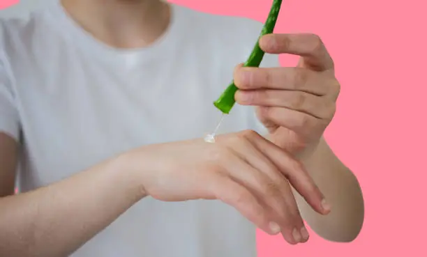 Aloe vera gel for sunburn