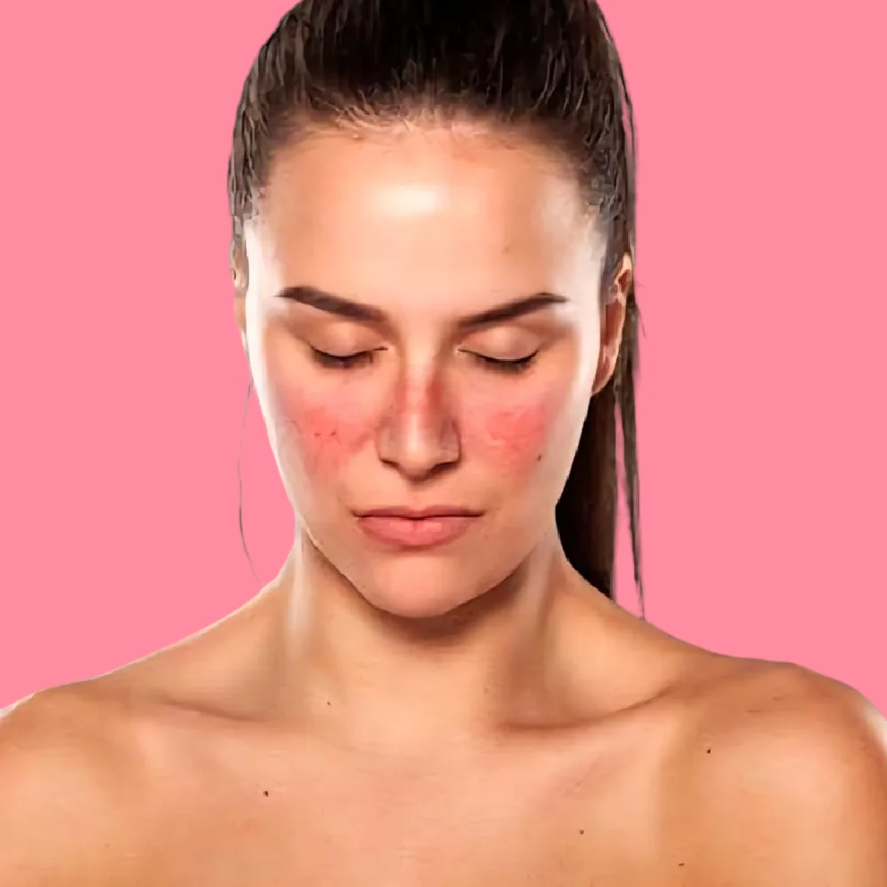 causes of lupus in women 