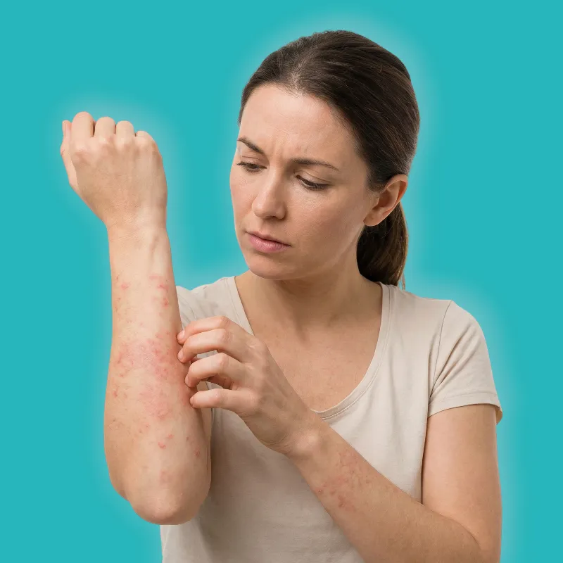 توب فلام مرهم لعلاج التهابات الجلد المصاحبة للحكة والاحمرار