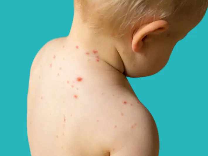chickenpox