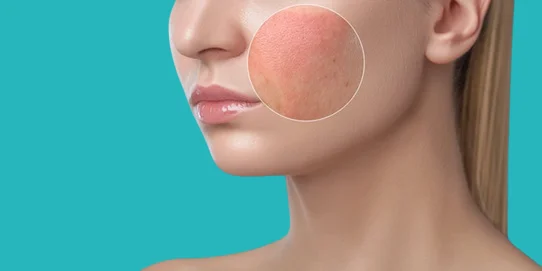 dermatitis