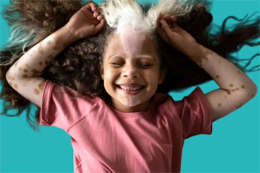 causes of vitiligo in children and treatment methods 