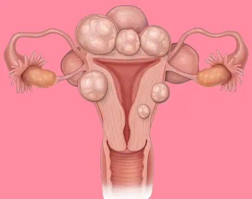 uterine tumors
