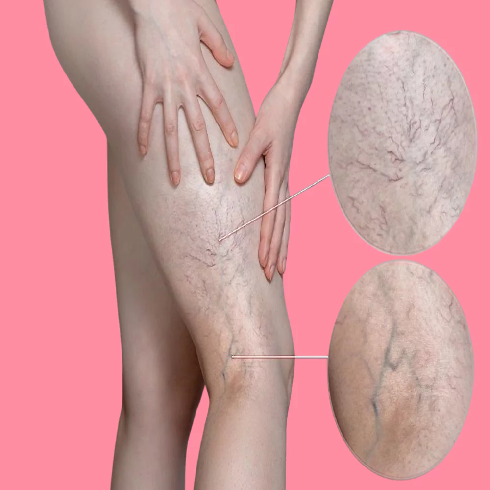 What are varicose veins, their relationship to pregnancy, and how can they be treated? 