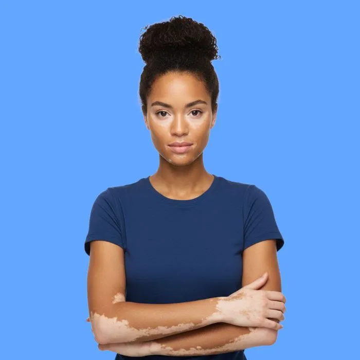 vitiligo: causes, symptoms, and treatment