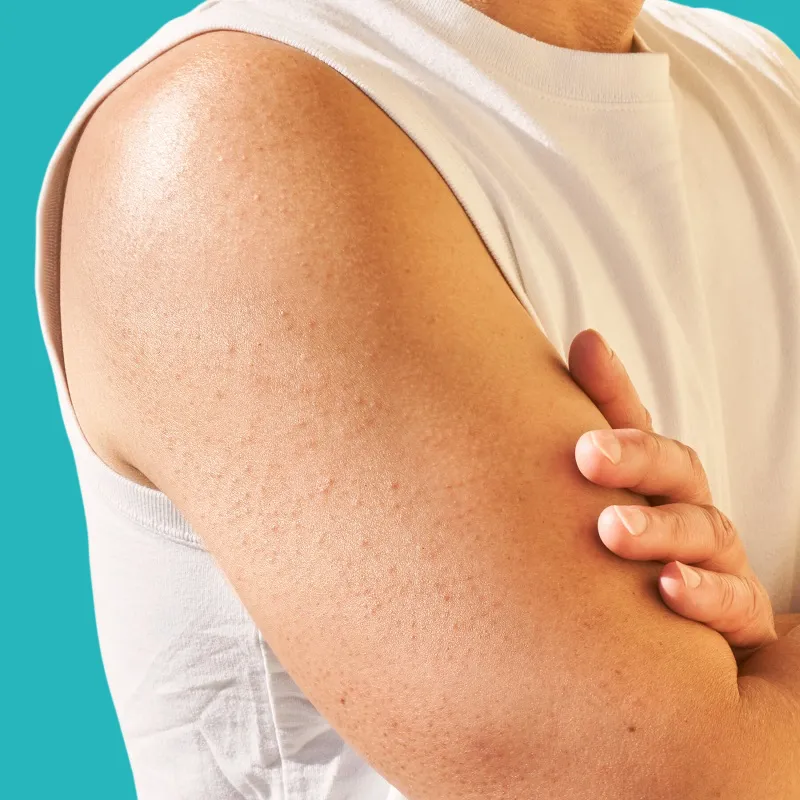 methods for treating and permanently getting rid of keratosis pilaris 