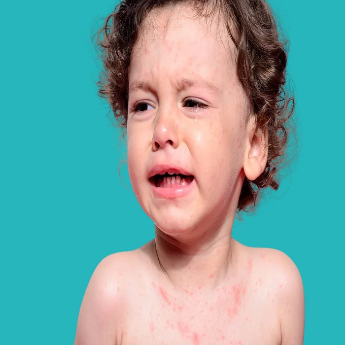 the best cream for treating heat rash in children 