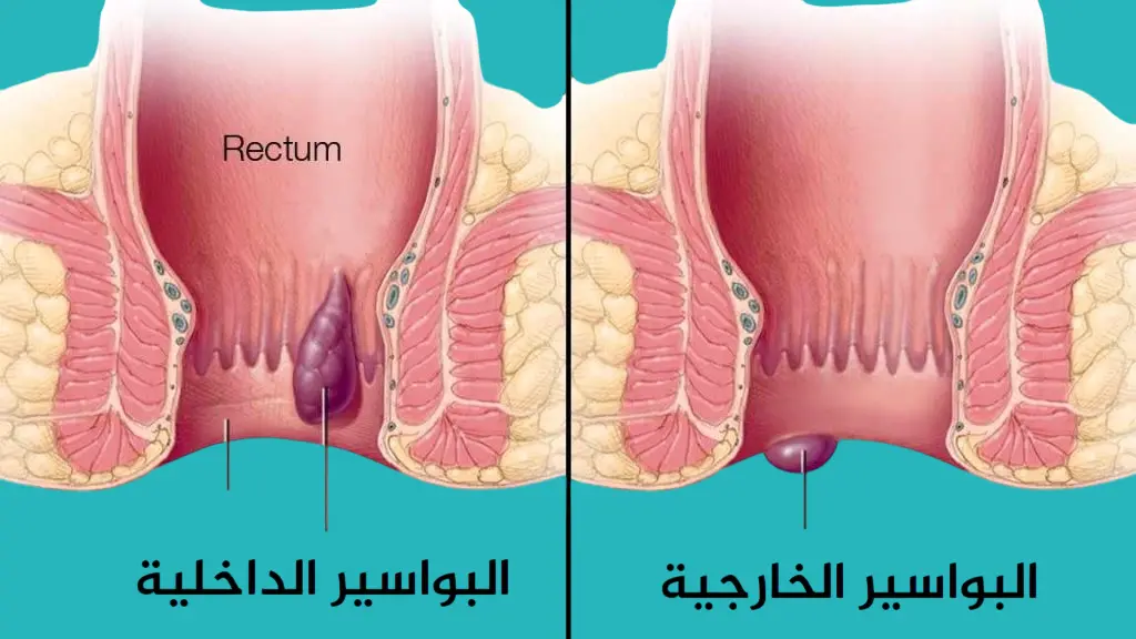 البواسير الداخلية والخارجية
