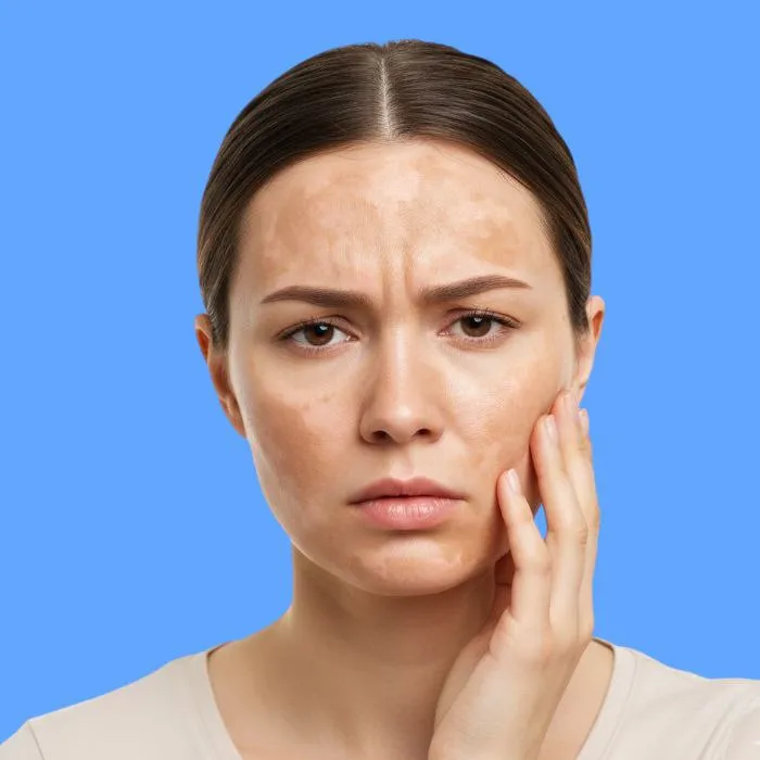 melasma: causes, symptoms, and treatment
