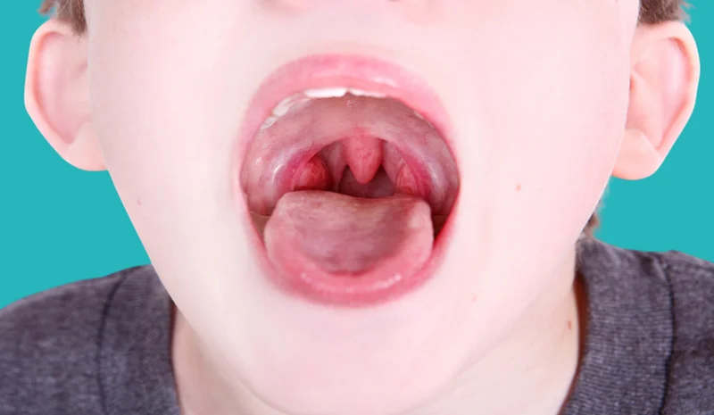 tonsil enlargement