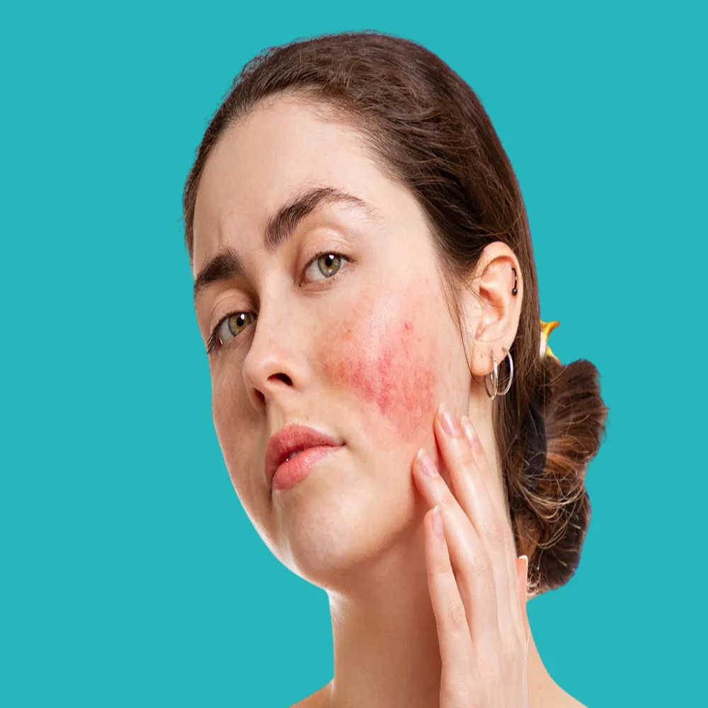 what is the difference between acne and rosacea 