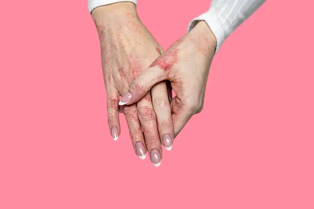 Causes of skin inflammation after laser treatment