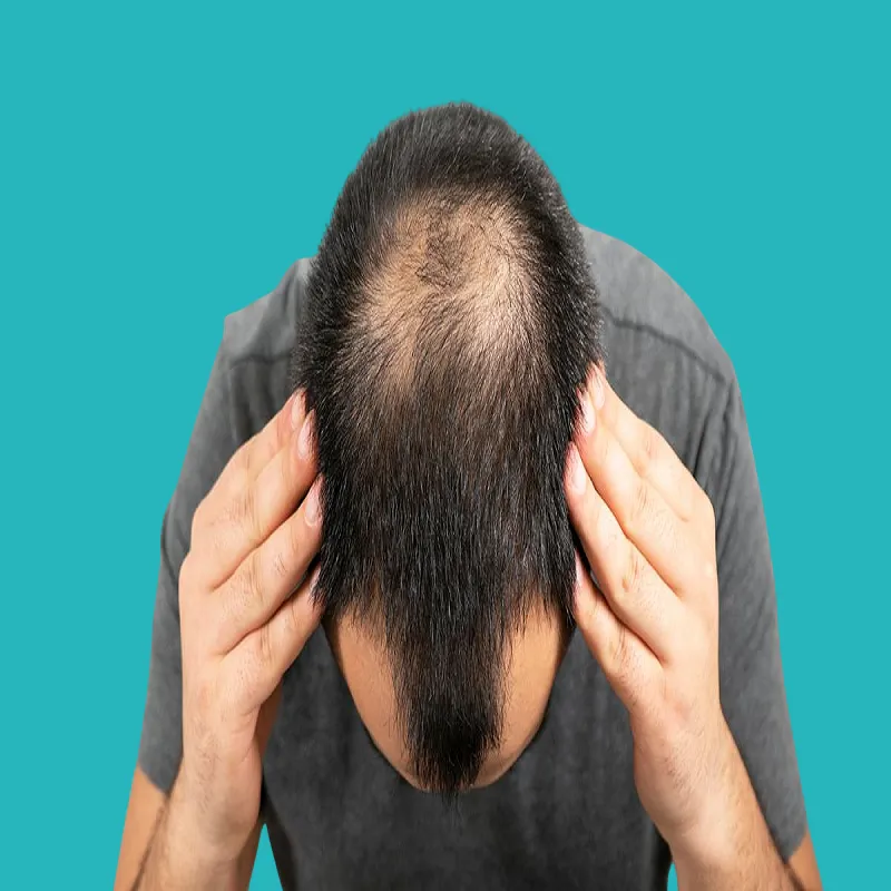 طرق علاج الصلع الوراثي وعلامات حدوثه 