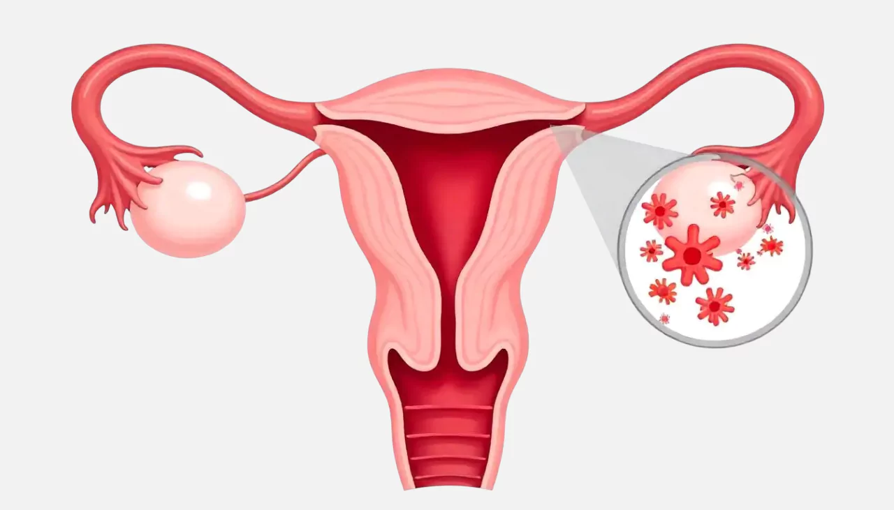 bacterial vaginosis